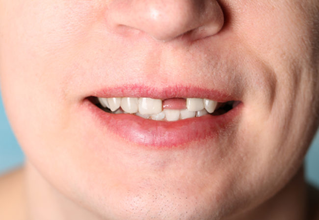 Smile of man without one front tooth